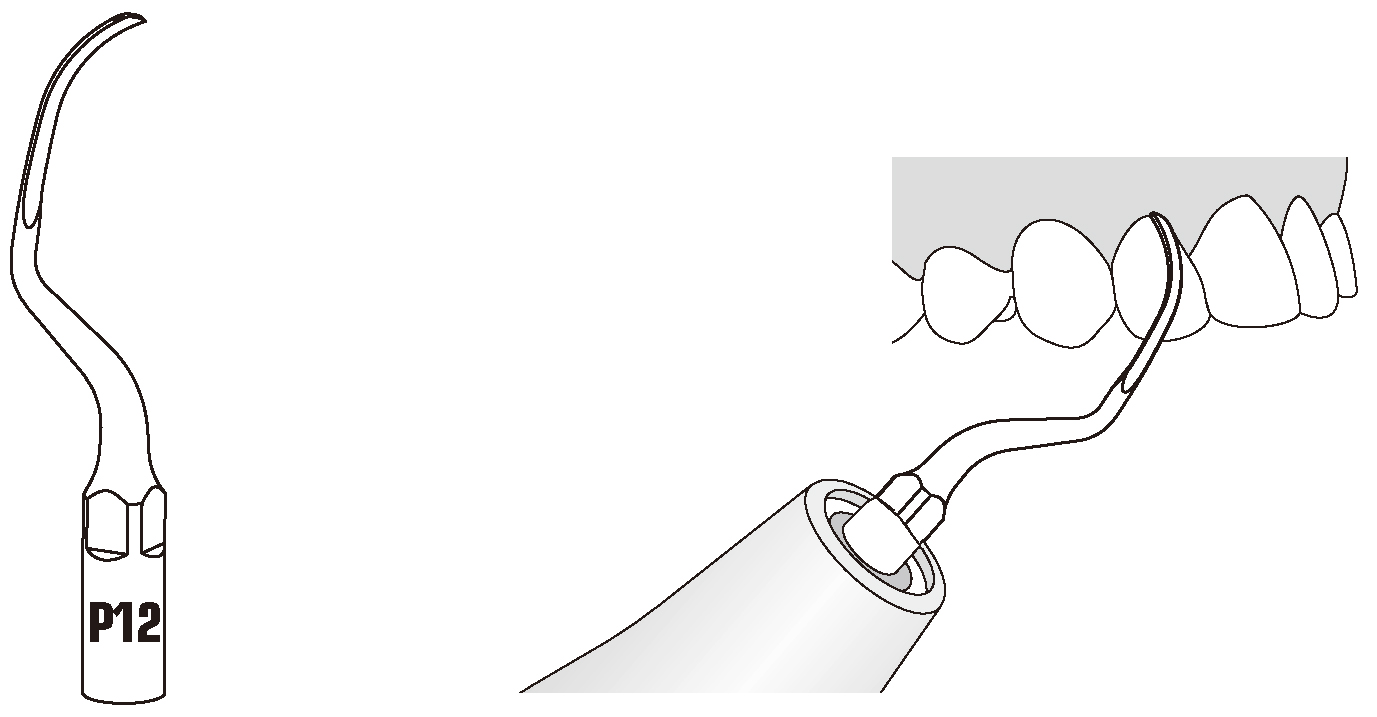 Сфера применения наконечника для скалера